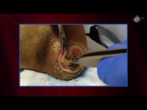 WCW: Natural Maggot Therapy