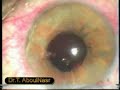 phaco in small pupil with pupillary dilator (Morcher) phaco in small pupil with pupillary dilator (Morcher)
