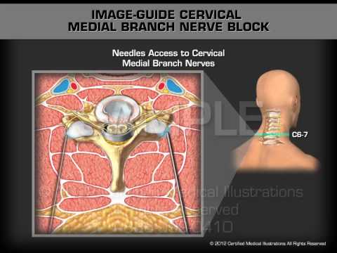 Epidural steroid injection neck youtube