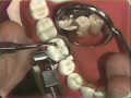Packing of Class II Amalgam for Hygienists