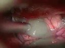 Neurosurgery: Craniopharyngioma Supra-Orbital Removal