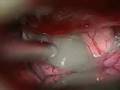 Neurosurgery: Craniopharyngioma Supra-Orbital Removal
