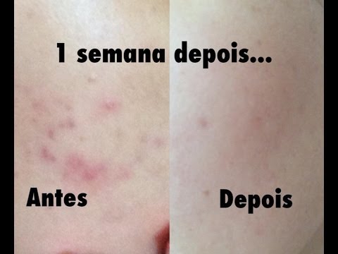 Como se livrar em 1 semana definitivamente da acne(espinhas) l Trate em casa - Por Carolinna Silva