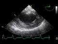 videos de TEE Inf wall air embolism