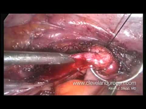 ovaries - Part 4 of a narrated, full-length total laparoscopic hysterectomy and removal of both ovaries for fibroids and pelvic pain. A Ligasure device is used to seal...