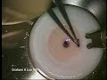 New technique for combined corneal and cataract surgery