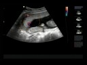 20 Week Sonogram (2 of 3)