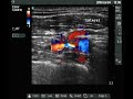 Ultrasound view of the brachial plexus (infraclavicular)