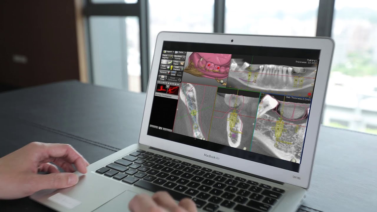 《4D導航植牙》松山牙醫植牙推薦，全新配備安適準4D微創導航｜紀泓輝牙醫