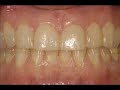 Veneers Dental