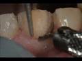 Veneers Dental