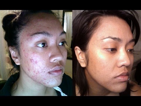 how to use benzac ac for acne