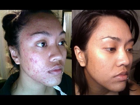 how to use dalacin c for acne