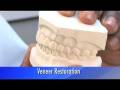 videos de Veneer Restoration
