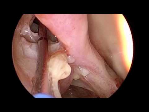 how to drain frontal sinus