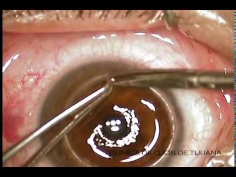 how to transplant eyes