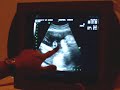 Ultrasound May 2006