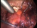 Kidney-Preserving Renal Cell Cancer Resection - Endoscopy Kidney-Preserving Renal Cell Cancer Resection - Endoscopy