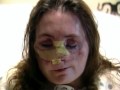 US-Patientin zeigt neues Gesicht nach spektakulärer Operation