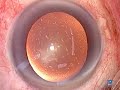 Topical Local Anaesthesia Phaco basic techniques Topical Local Anaesthesia Phaco basic techniques