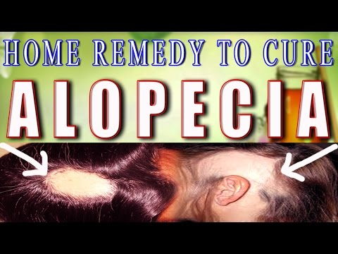 how to cure alopecia