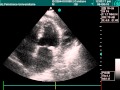 Pericardial Effusion In Echocardiography Examination Pericardial Effusion In Echocardiography Examination