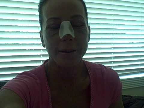 My Facial Plastic Surgery Blog - Recovery Day 14