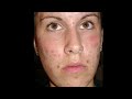 Fruchtsäurepeeling / Naturkosmetik gegen Pickel - Beautyline-Studio Monika Kahl