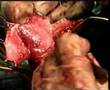 The Krishnamurti Operation for Peyronie's Disease (5 of 7)