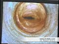 ny plastic surgery Dr Vitolo transumbilical breast augmentation video