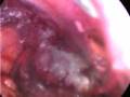 videos de Hernioplastia lumbar.wmv
