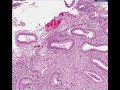 Histopathology Uterus, endometrium--Secretory endometrium Histopathology Uterus, endometrium--Secretory endometrium
