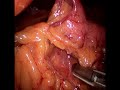 laparoscopic sleeve gastrectomy