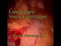 laparoscopic sleeve gastrectomy