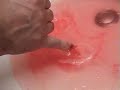 Hawaiin Zip-Line Mishap ( Blood Spraying - Ripped Off Fingernail ) Hawaiin Zip-Line Mishap ( Blood Spraying - Ripped Off Fingernail )
