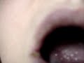 Oral Herpes Simplex ... Cold Sore #02  Cold Sore Herpes Simplex