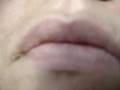 can you get herpes simplex 1 on your tongue