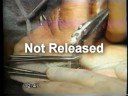 Inflatable Penile Prosthesis Part 2 (AMS 700 CX)