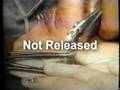 Inflatable Penile Prosthesis Part 2 (AMS 700 CX)