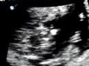 Ultrasound video 12 weeks June 10 (1)