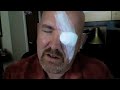 Surviving Eye Surgery (Chalazion)