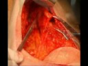 Skin sparing mastectomy e ricostruzione mammaria, lembo latissimus dorsi esteso Skin sparing mastectomy e ricostruzione mammaria, lembo latissimus dorsi esteso