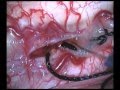 Cervical intramedullary astrocytoma - Posterior approach