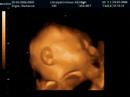 3D Ultrasound of Jacob - 6