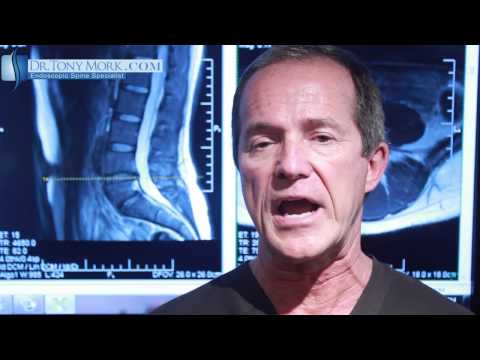 Annular Tear Treated with Laser by Dr. Tony Mork