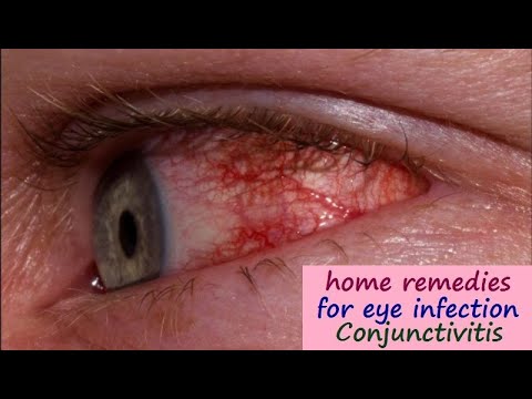 how to treat viral pink eye