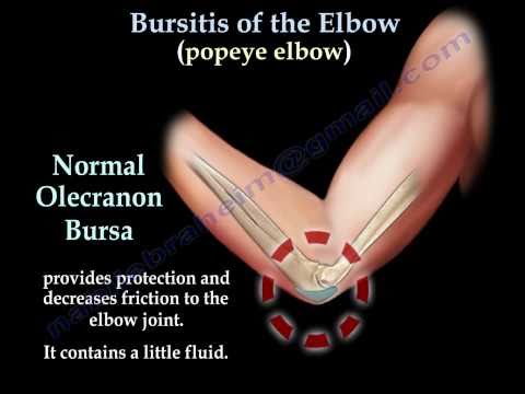 how to cure olecranon bursitis