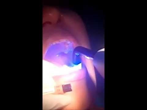 how to whiten teeth if you have fillings