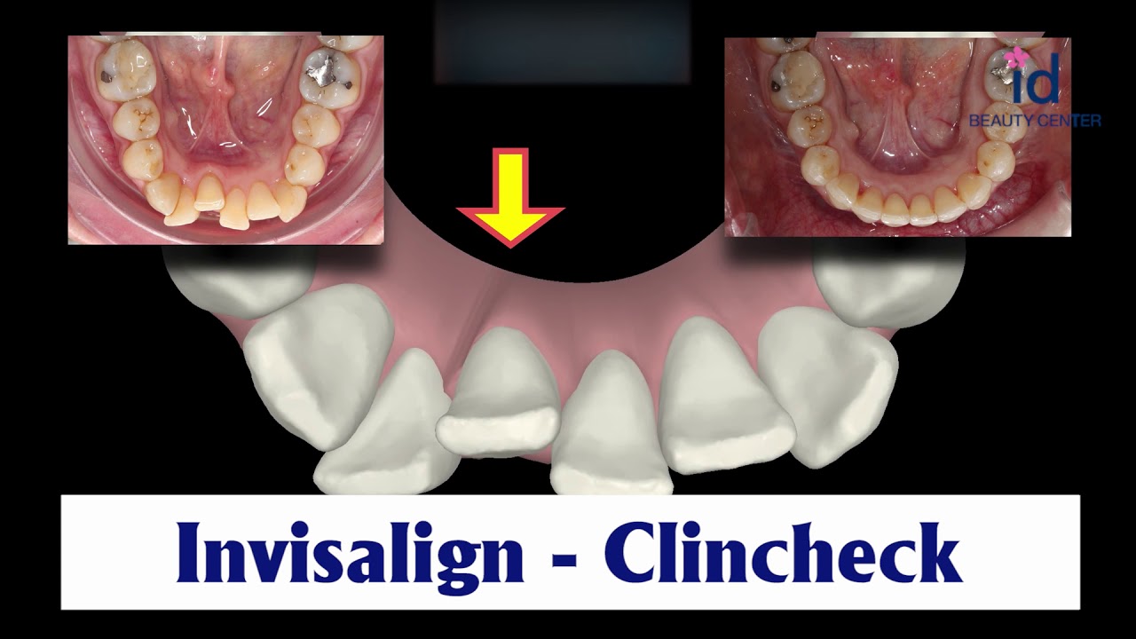 Invisalign | Clincheck