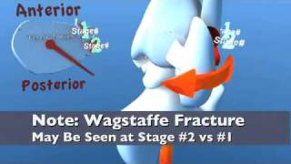Lauge Hansen SER Supination External Rotation (Eversion) Ankle Fracture